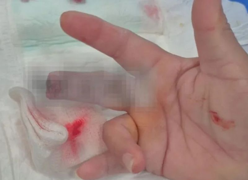 Una enfermera sufrió la amputación de parte de su dedo por un paciente exaltado en General Pinedo