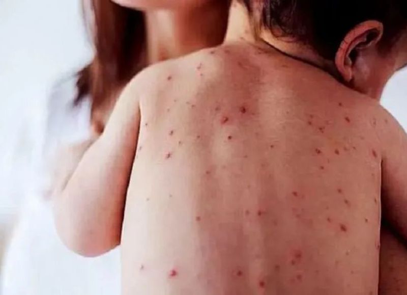 Salud reforzó la vigilancia y llamó a completar vacunas contra el sarampión